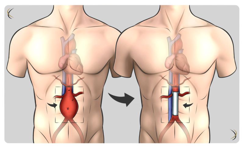 Aneurisma de aorta Aneurisma de aorta