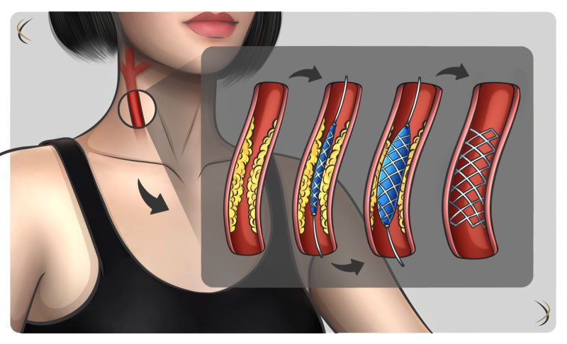 Angioplastia de artérias carótidas Angioplastia de artérias carótidas
