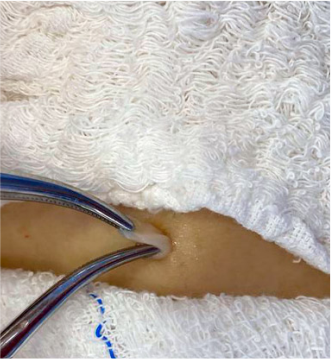 Microcirurgia